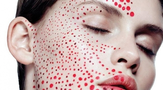 Rumień, naczynka, trądzik różowaty rozwiązanie problemu