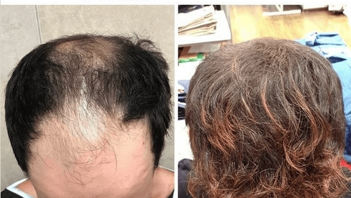 Dlaczego warto wybrać przeszczep włosów w Turcji z Flymedica? Odpowiadamy!