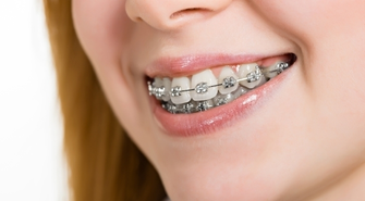 Proste zęby w każdym wieku – czyli dlaczego warto nosić aparat ortodontyczny