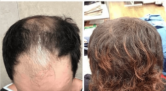 Dlaczego warto wybrać przeszczep włosów w Turcji z Flymedica? Odpowiadamy!