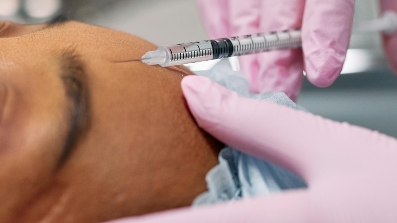 Mezoterapia igłowa rewolucyjna metoda regeneracji skóry