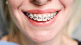 Jak prawidłowo czyścić aparat na zęby?