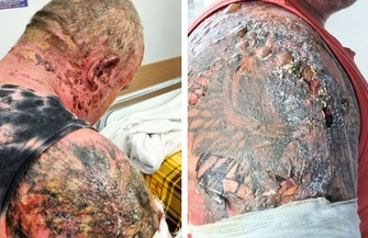 Wystartowała zbiórka dla Łukasza. Prosiłem żonę żeby uciekała z naszymi dziećmi