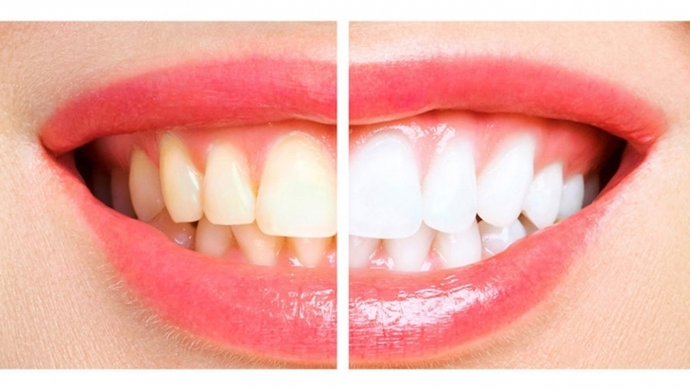 Kto może mieć hollywoodzki uśmiech?