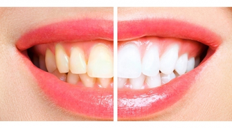 Kto może mieć hollywoodzki uśmiech?