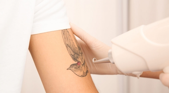 Usuwanie tatuażu – jak wyglądają nowoczesne zabiegi?